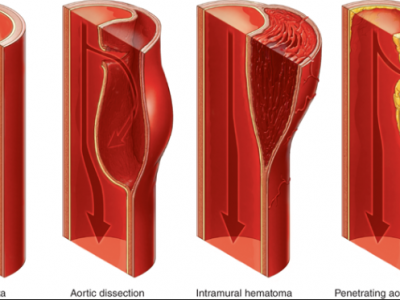 Disekcija aorte