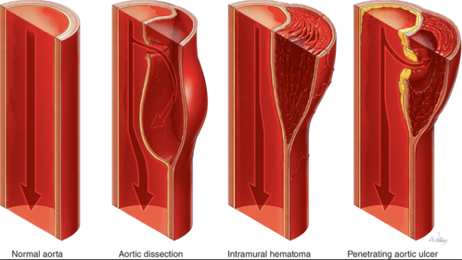 Disekcija aorte