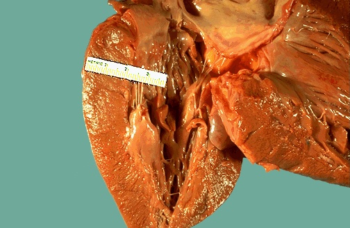 Hipertenzijska bolest srca