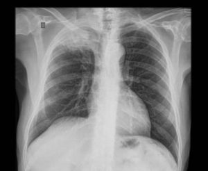 Tumori pluća