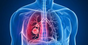 tumori pluća