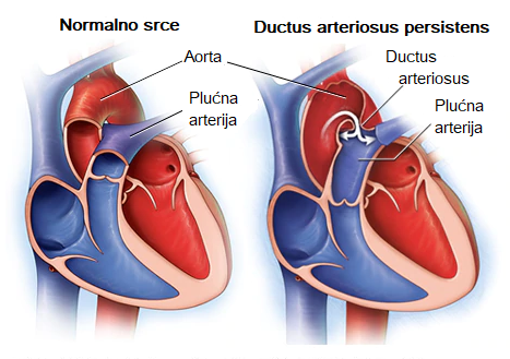 ductus-arteriosus-persistens