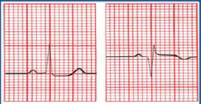 EKG - infarkt miokarda