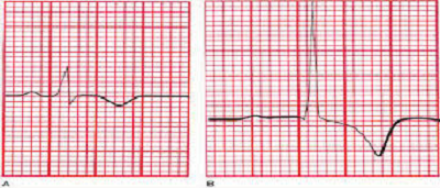 EKG - infarkt miokarda