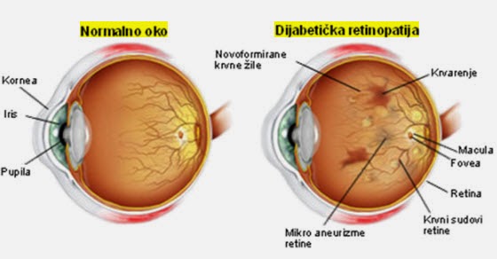Dijabeticka retinopatija