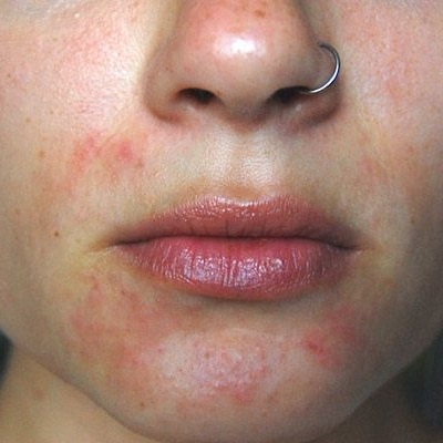 seboroicni dermatitis