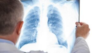 virusne-i-bakterijske-pneumonije