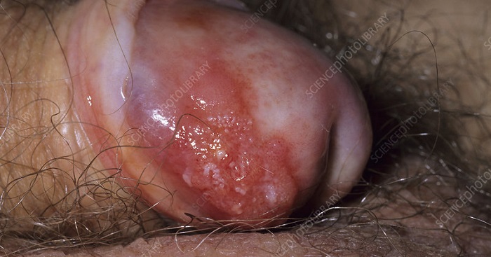karcinom penisa
