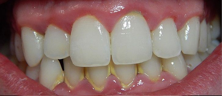 zubni-plak-biofilm-1