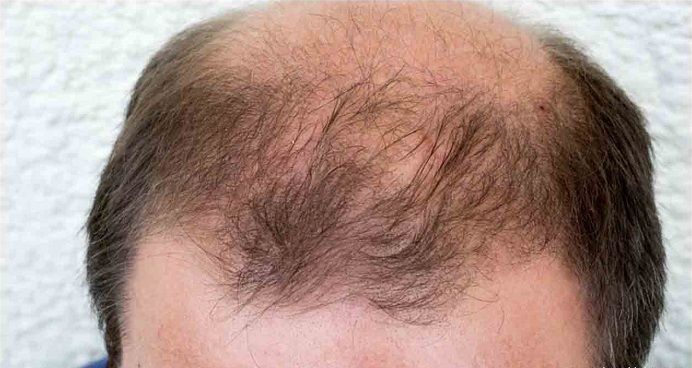 alopecija-celavost