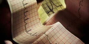 ekg-blok-desne-grane-37