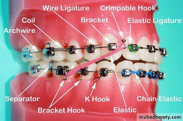 Fiksni ortodontski aparat