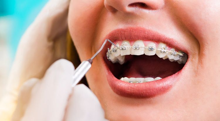 Podela ortodontskih aparata