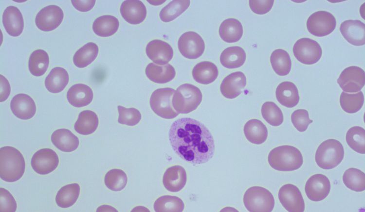 megaloblastna anemija