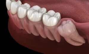 perikoronitis-25