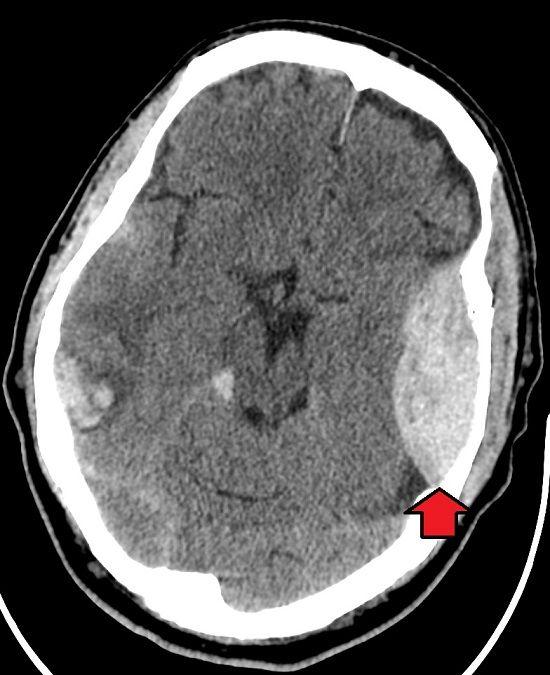 epiduralni hematom dijanostika neurotraume