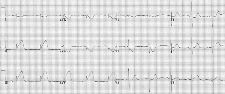 EKG infarkt miokarda donjeg zida